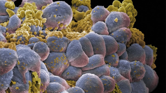 Researchers isolate cells implicated with breast cancer-derived brain tumors